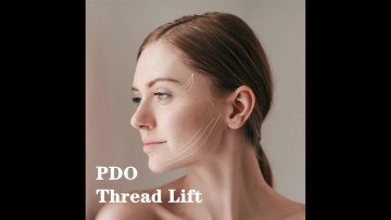 SHANGYANG instalift korean protein thread lifting set pdo mono threads 25mm face lift needle pdo threading1