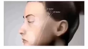 Thread lift face tornado sculptra plla filler threads face lift1