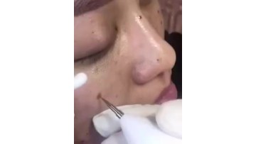 A  plasma pen dual-purpose electric tag laser mole remover1