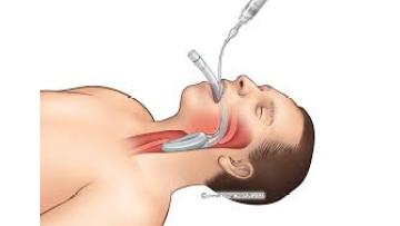 an successful intubation of laryngeal mask airway