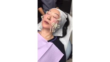 Korea Hot selling medical Non-Surgical Absorbable hilos pdo thread mono 29G 50mm face eyebrow lifting mono pdo thread1