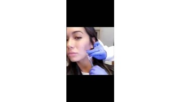 Korea collagen mono blunt 30g 38mm pdo thread silk protein thread lifts tighten collagen thread face lifting1