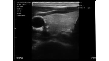 Carotid artery 5N.MP4