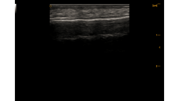 forehead (15L high frequency handheld probe)