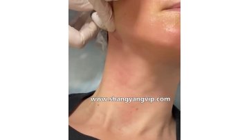 Absorbable face  body sculptra plla filler plla injection hilos plla1