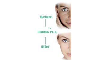 Reborn plla dermal filler