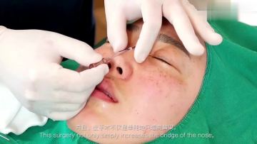 High quality pdo threads for nose thread lift face tornado gold thread face lift1
