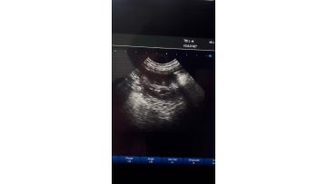PU-VDL121A  ultrasound scanner