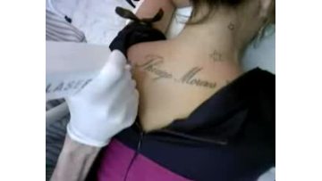 Q switched nd yag laser treatment 