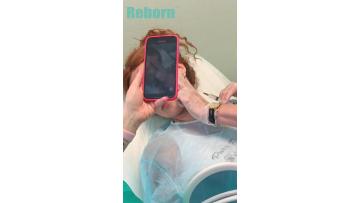 Reborn PLLA Filler For Jawline Lifting