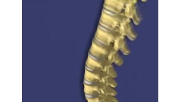 Balloon Kyphoplasty for VCFs