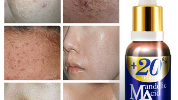 Custom Private Label Organic Natural Vegan Anti Acne Face Skin Care Remove Blackheads Mandelic Acid Serum1