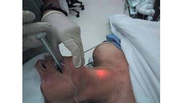 what is a lighted stylet for intubation