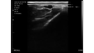 uprobe-5P wireless ultrasound.MP4