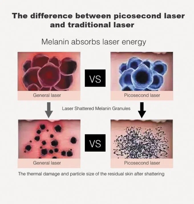 Picosecond Laser 1