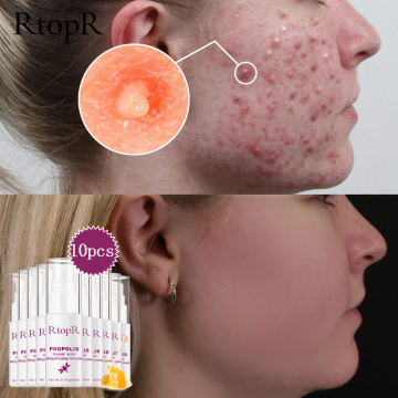 10Pcs Propolis Repair Acne Serum Skin Brightening Cream Acne Scar Cleansing Serum Shrinkage Elimination Acne Treatment Skin Care