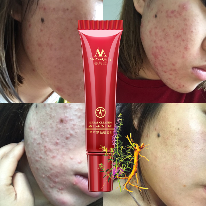 Face Acne Cleaning Cream Skin Care Remove Repair Comedone Pimple Acne Quickly Face Acne Cream Remover Anti Acne Treatment