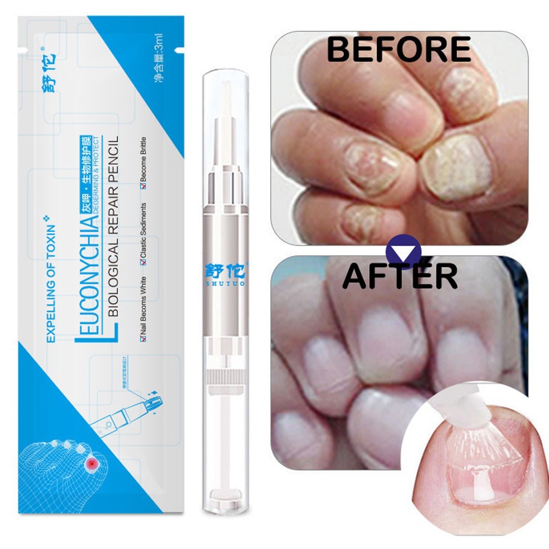 5/3/1PCS Powerful Nail Treatment Pen Onychomycosis Paronychia Anti Fungal Nail Infection Cuticle Oil Pen Nail Treatments TSLM2