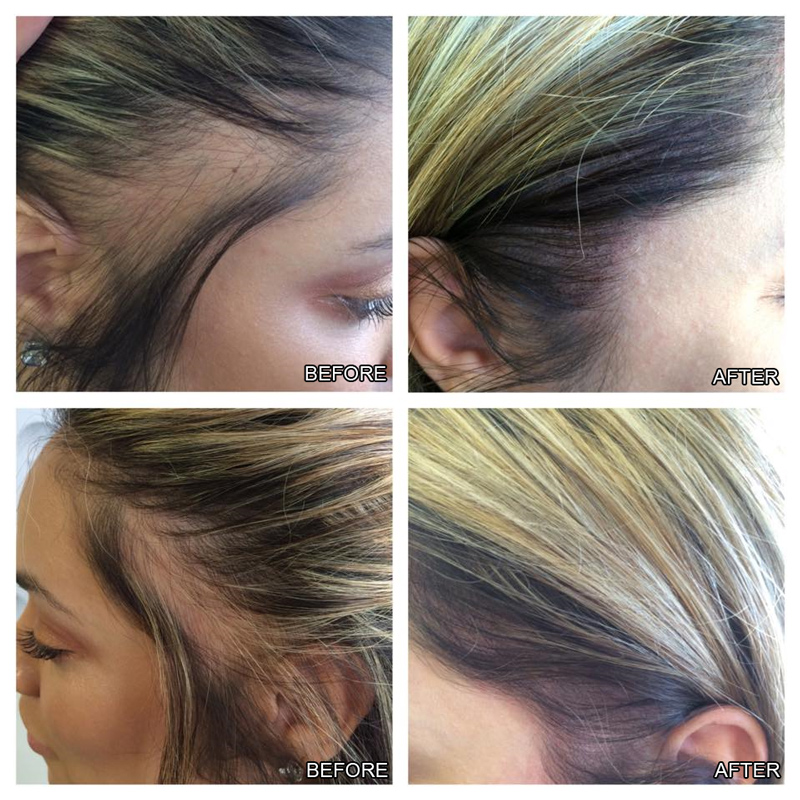 MBA Hair Growth Serum Derma Scalp Intensive Ampoule Triple Roll Massager Fast Regrow Hair Line Hair Loss Essence