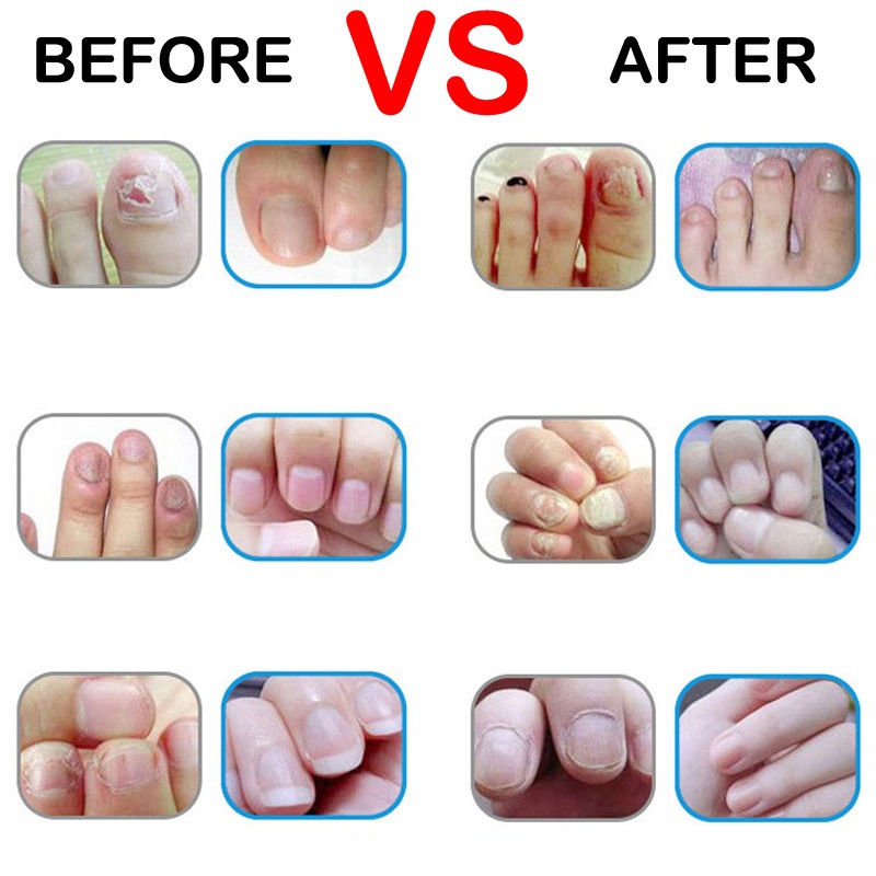 2PCS Effectively Eliminate Nail Fungus Pen 3ml Onychomycosis Paronychia Herbal Toe Finger Nails Infection Medicinal TSLM1