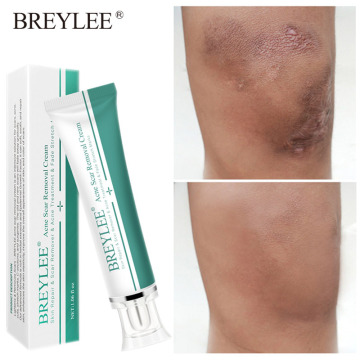 BREYLEE Hyaluronic Acid Scar Removal Cream Treatment Acne Repair Skin Removal Stretch Mark Melanin Whitening Cream Skin Care