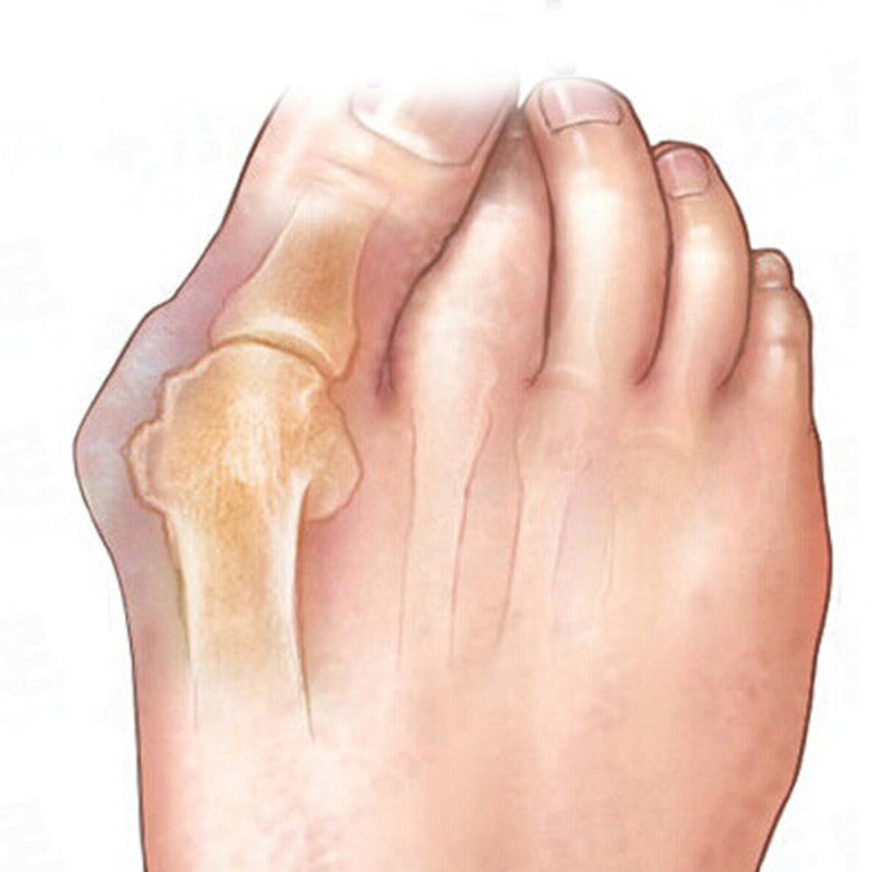 Soft Silicone Cirrhotic 8 Pieces/4 Pairs Silicone Toe Separator Hallux Valgus Straightener Corrector Foot Massage Interchange