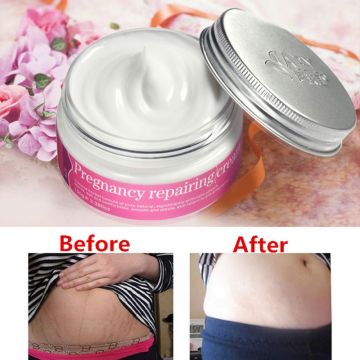 AFY Natural Herbal No Side Effects Pregnancy Repair Cream Stretch Mark Remover Maternity Relieve Fat Grain Skin Care Products M9