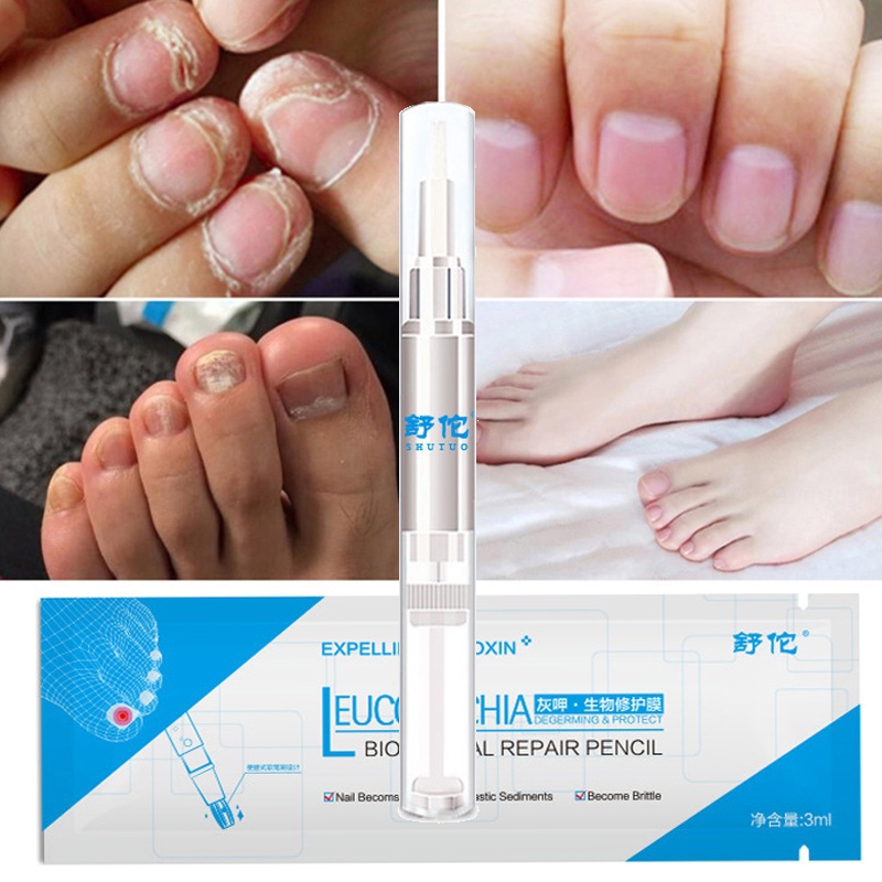 Nail Liquid Anti Nail Toenail Fungus Pen Nail Treatment Cuticle Oil Pen Nail Solution Anti Fungal Tool TSLM2