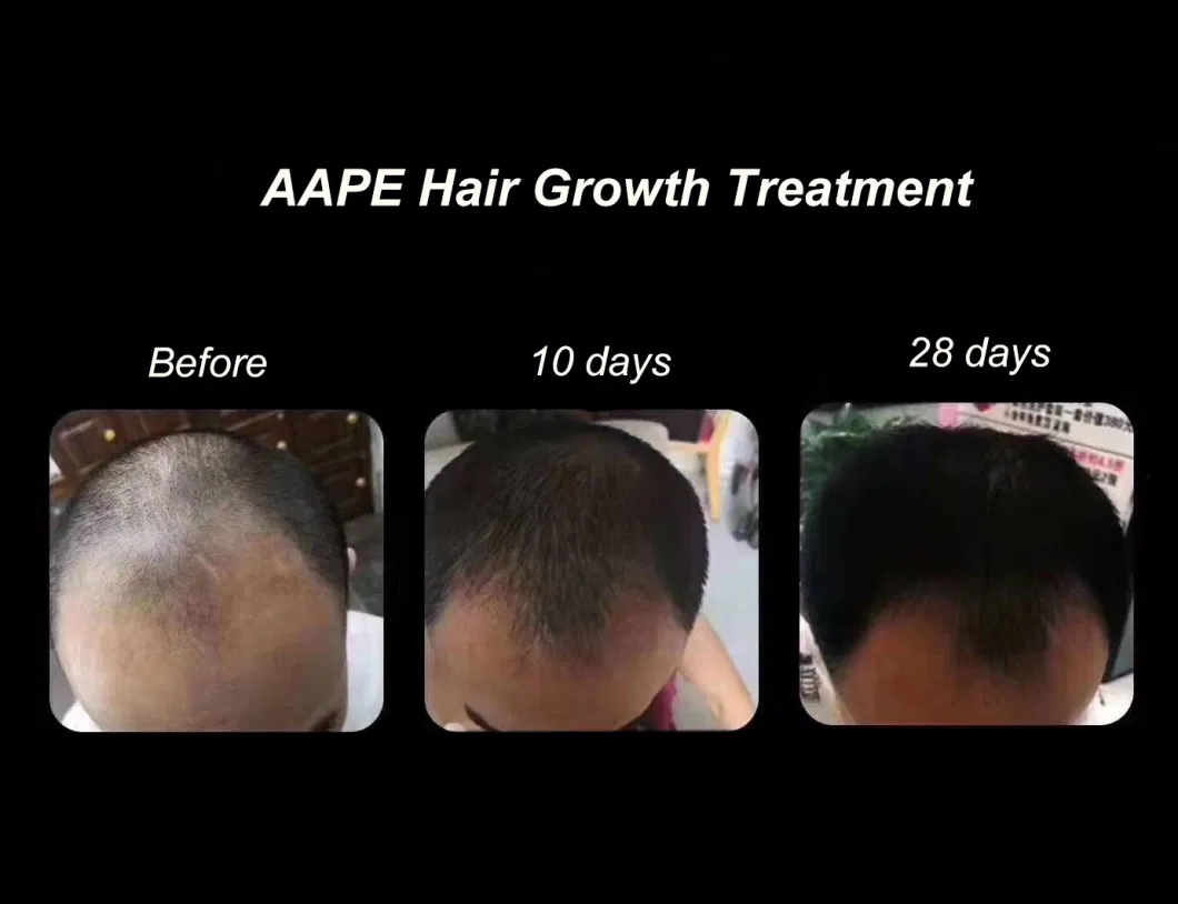 Aape-Stem-Cells-Exosome-Hair-Loss-Therapy-Aape-Efficient-Hair-Growth-Products-Stem-Cell-Growth-Anti-Hair-Loss-Treatment-for-Human.webp (6)