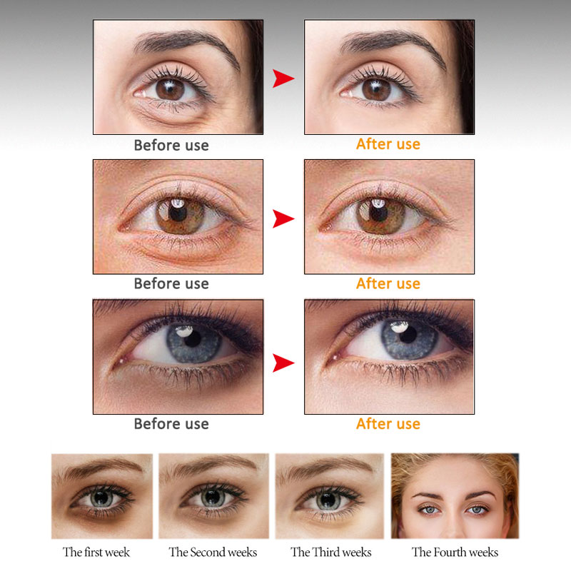 ARTISCARE Liusheng Titanium Anti Wrinkles eye cream Roller Massager Eye Patches Anti Puffiness Remove Fine Lines Dark Circles