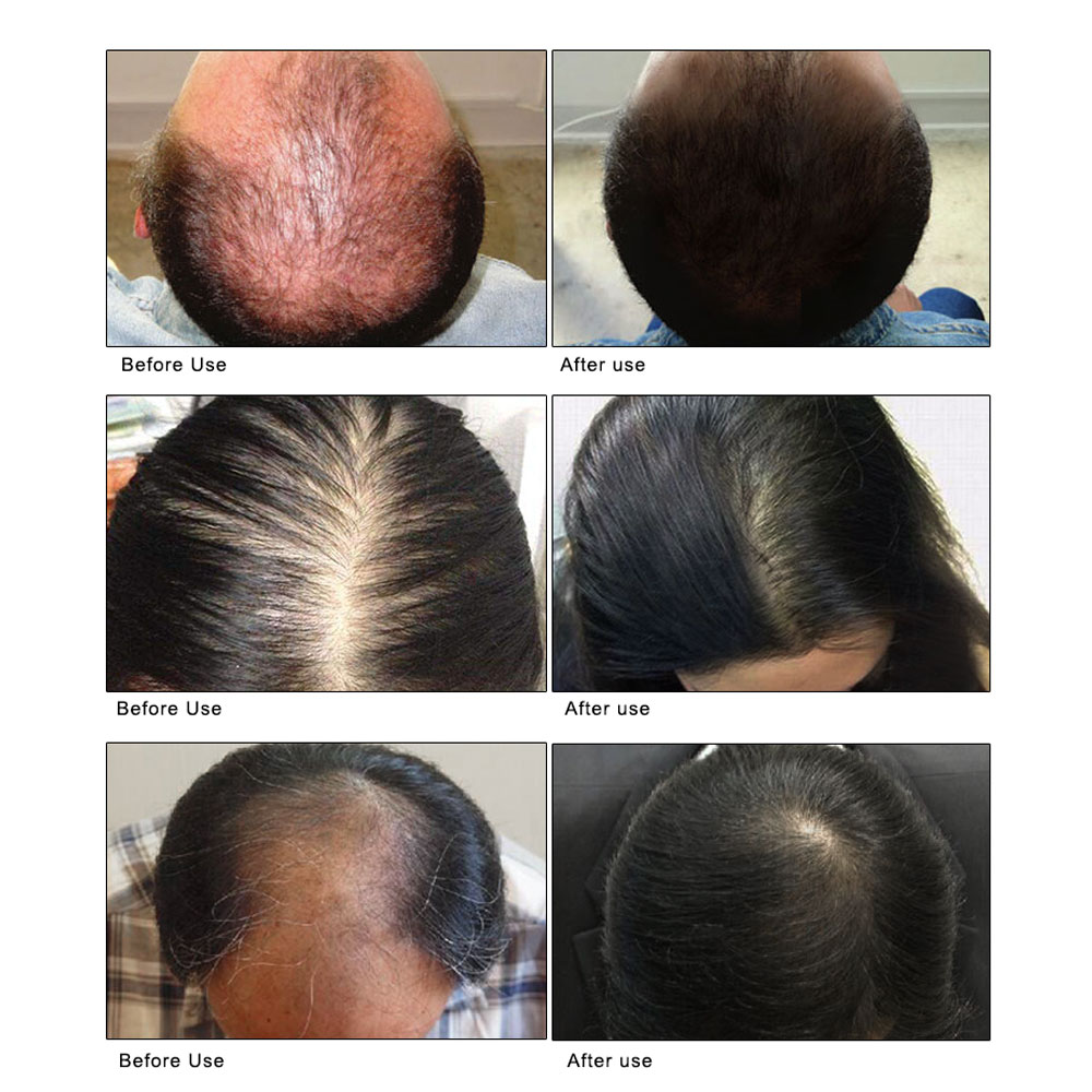 ARTISCARE Hair Loss Growth Spray Hair Oil Keratin Hair treatment Prevent hair Promote hair growth Nouish the scalp Thick Hair