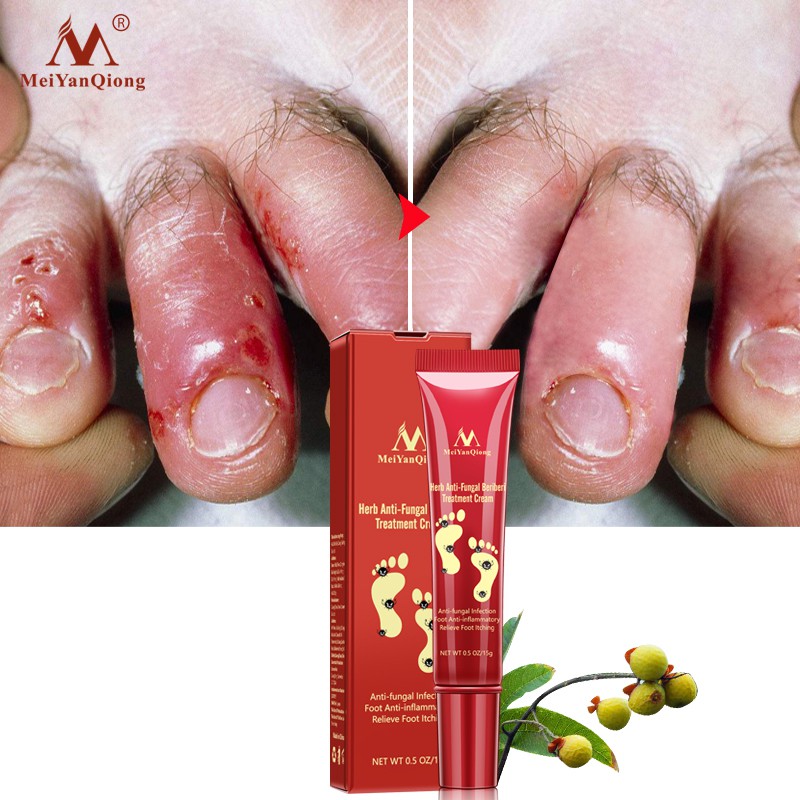 Foot Care Anti Fungal Infection Feet Repair Herbal Relieve Beriberi Treatment Cream 15g