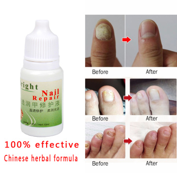 100% Kills Fungus Nail Fungal Treatment Cream Onychomycosis Paronychia Anti Infection Plaster Essence Feet Care Whitening Toe