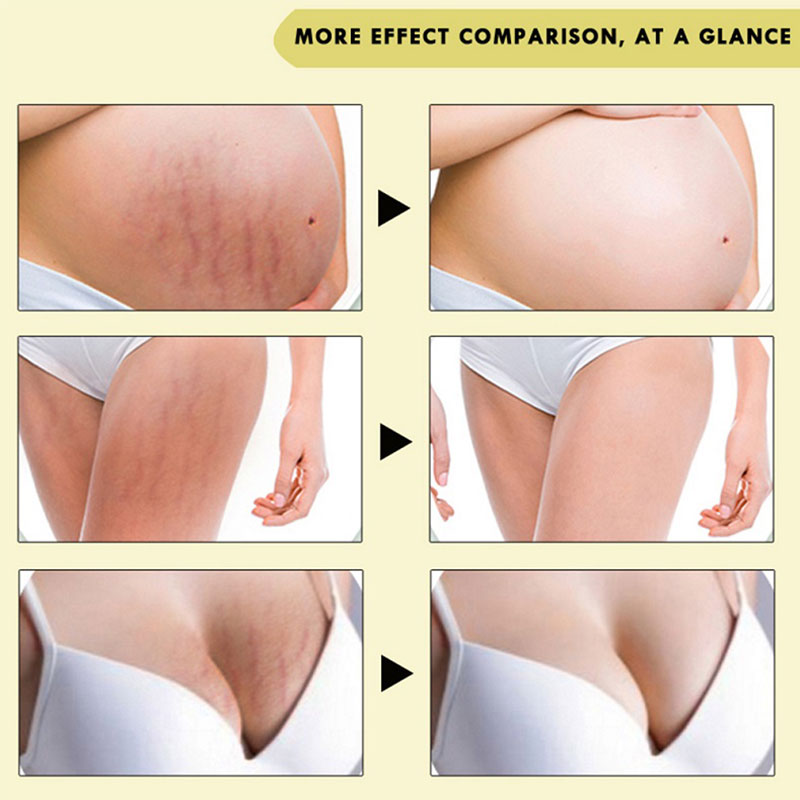 Stretch Marks Body Cream Care Maternity Stretch Marks Remover Thailand Postpartum Obesity Pregnancy Scar Removal Tight Skin Care