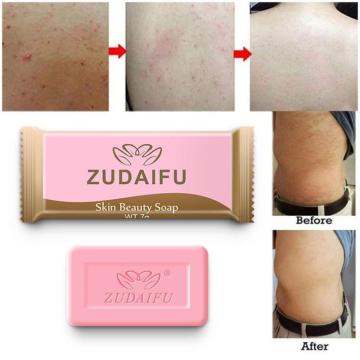 Zudaifu Sulfur Soap Skin Conditions Acne Psoriasis Seborrhea Eczema Anti Fungus Bath Whitening Soap Shampoo Skin Care TSLM1