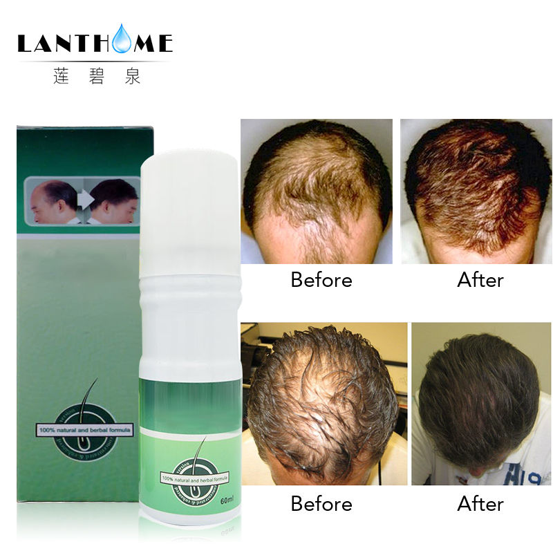 3 bottles Lanthome Pilatory Extra Strength Herbal Anti Hair Loss Treatment Serum Fast Hair Growth Spray Sunburst Alopecia Areata