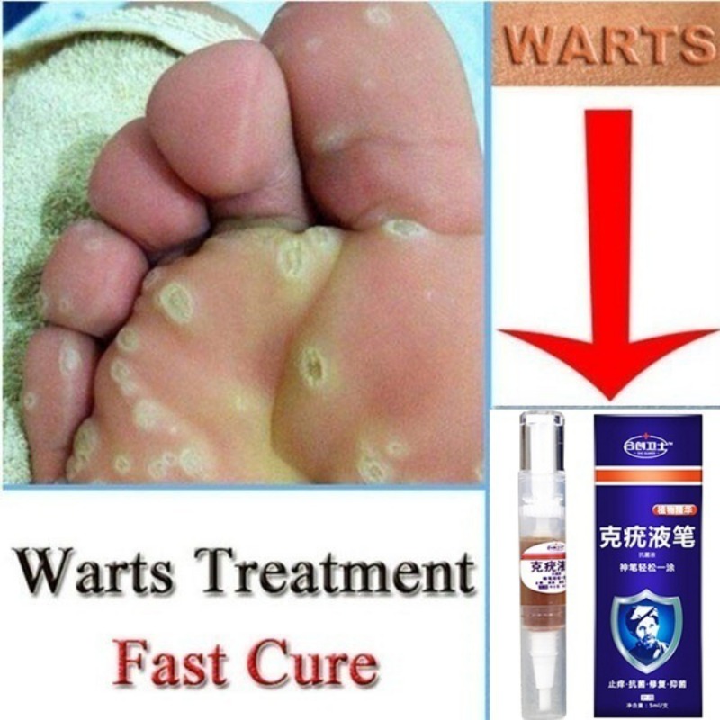 5ML Skin Care Plantar Wart Remover Corn Callus Remover Removal Liquid Pen Stops Regrowth