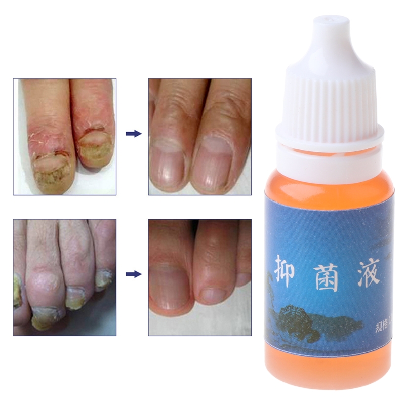 Drop Ship&Wholesale 10ml Nail Repair Onychomycosis Remover Fungus Anti Fungal Toe Treatment Liquid Nov.18