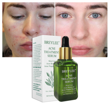 17ML Acne Treatment Face Serum Mask Anti Acne Pimple Scar Remover Moisturizing Whitening Skin Care Facial Essence Cream