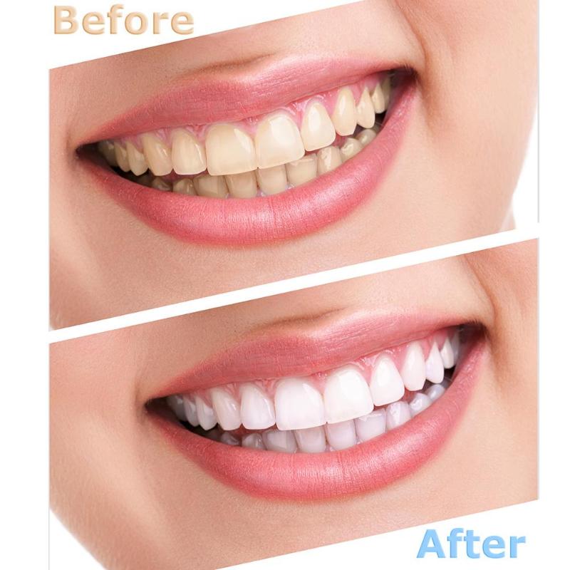 100pcs Temporary Crown Porcelain Teeth Veneers 50pcs Anteriors Front + 50pcs Molar Posterior Veneers Teeth Oral Care