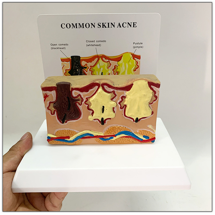 Common Skin Acne Enlarge Skin Structure Anatomical Model Tissue Hierarchical Micro Plastic Surgery Suture Beauty Teaching