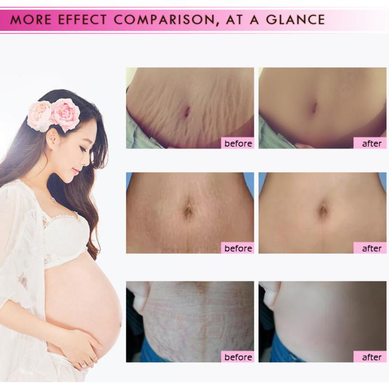 Mango Remove Pregnancy Acne Scar Stretch Mark Cream Treatment Maternal Anti-Aging Repair Anti-Wrinkle Firming Body Cream TSLM2