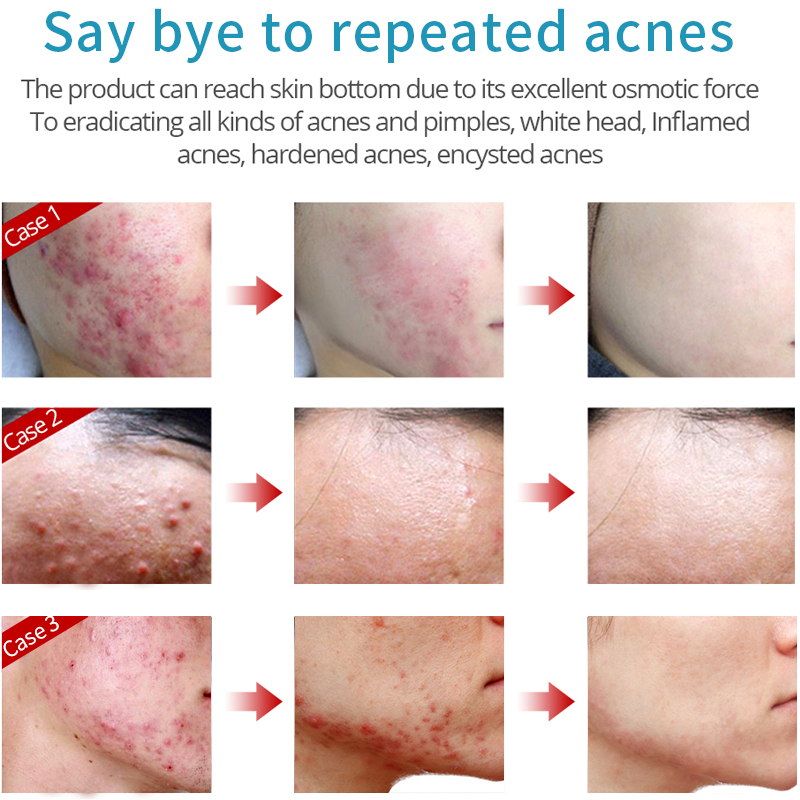 Hemeiel Acne Cream Acne Treatment Anti Pimples Spot Acne Scars Blackhead Removal Cream Beauty Skin Face Care Whitening Creams
