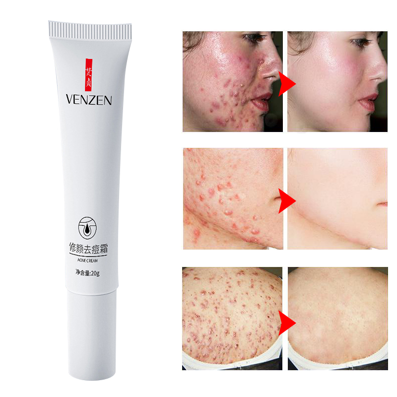 20g Acne Treatment Blackhead Removal Anti Acne Cream Oil Control Shrink Pores Acne Scar Remove Face Care Whitening Dropship TSLM