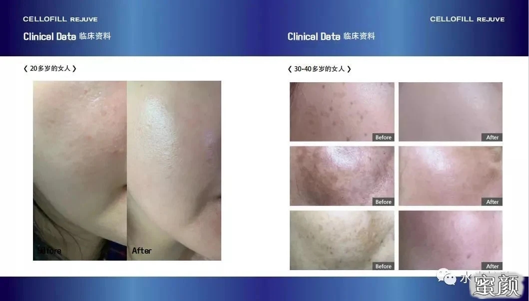 2022-New-Top-Selling-Korea-Origin-Chanel-Cellofill-Rejuve-for-Skin-Face-Reguventing-Anti-Aging-3ml-6vials-Skin-Booster-Dermal-Filler-Injection.webp (1)