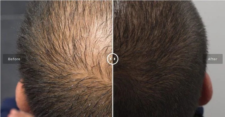 Innoaesthetics-Hair-Loss-Control-for-Man-to-Growth-Hair-Innoaesthetics-Hair-Loss-Control.webp (3)