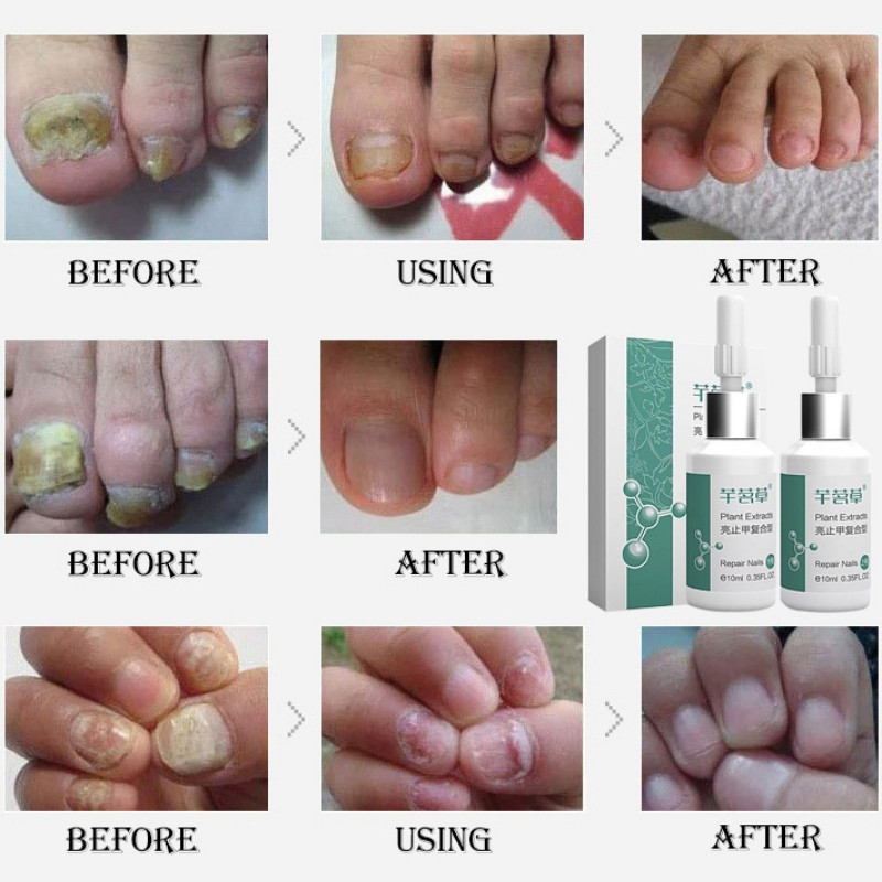 Nail Treatment Skin Liquid Pen Onychomycosis Paronychia AntiFungal Nail Infection Toe Medicine Fungus Repair Nourishment Fashion