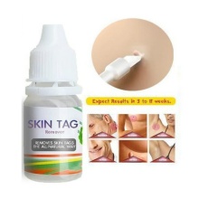 Skin Tag Remover Corn Eye Treatment Solution Corns Exfoliator Callus Removal Liquid Foot Skin Care Product