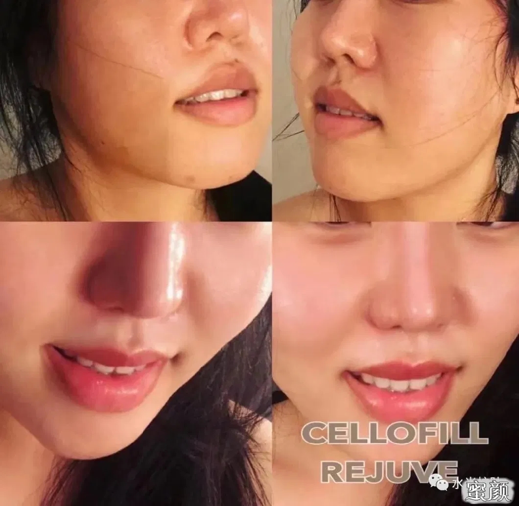 2022-New-Top-Selling-Korea-Origin-Chanel-Cellofill-Rejuve-for-Skin-Face-Reguventing-Anti-Aging-3ml-6vials-Skin-Booster-Dermal-Filler-Injection.webp (3)