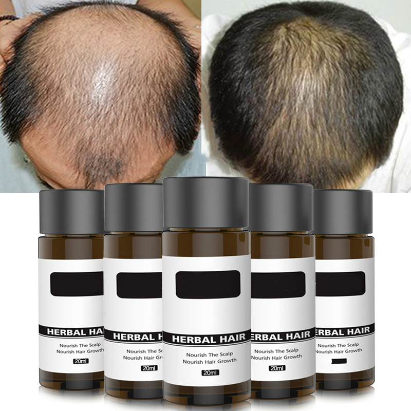 20ml Fast Hair Growth Ginger Hair Serum Essential Oils Dense Hair Growth Serum Hair Care Prevent Baldness Loss Serum